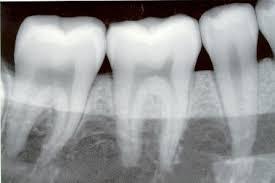 periapical